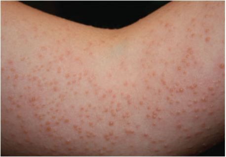Juvinal Solar Rash Intensely Pruritic Rash After Sun Exposure in a Tween Girl
