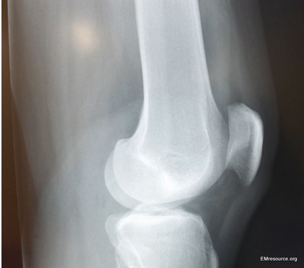 occult tibial plateau fracture occult tibial plateau fracture