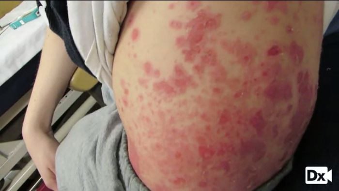 Boy Rash Back A 4-year-old Boy with Severe, Painful Rash