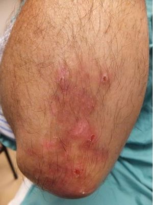 Dermatitis Herpetiformis