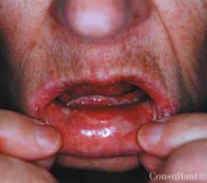 Prednisone for Stevens-Johnson Syndrome