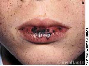 Peutz-Jeghers Syndrome