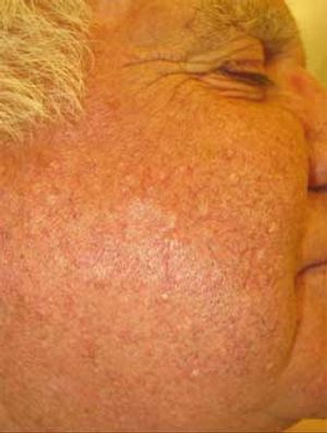 Sebaceous Hyperplasia