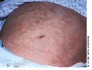 Erythema ab Igne After Frequent Heating Pad Use