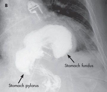how long can you keep glp 1 in the fridge How Long Does GLP-1 Last in Fridge: Storage Guidelines