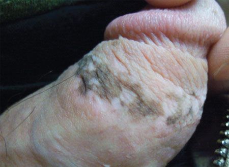 benign penile melanotic macules PDF] Penile Melanosis Associated with Lichen Sclerosus et Atrophicus: First  Description in the Medical Literature main image 1