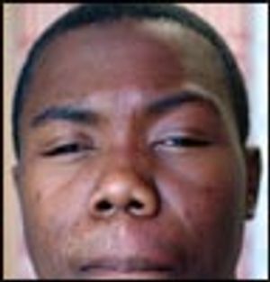 Teenager With One-Sided Facial Flushing and Progressive Vision Loss in Left Eye