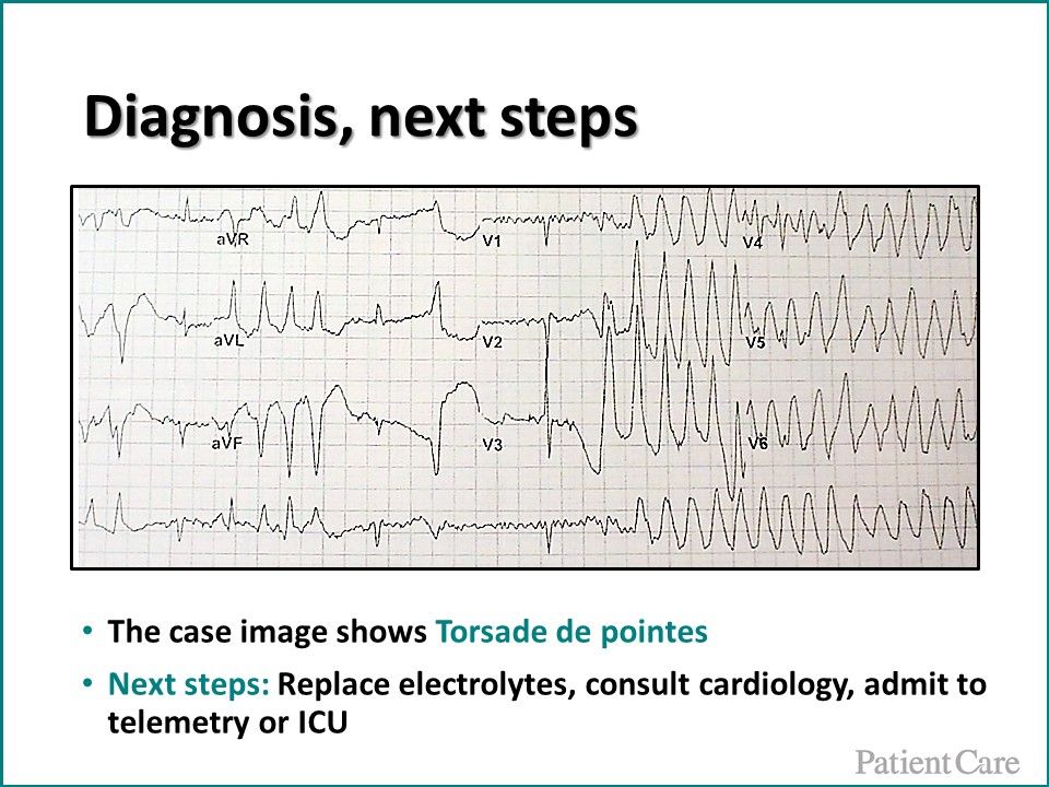 Torsade de pointes, ventricular tachycardia 