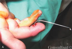Removing Fishhook From Finger