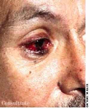 Kaposi's Sarcoma of the Eyelid in a Patient With AIDS