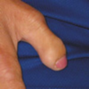 Larsen Syndrome