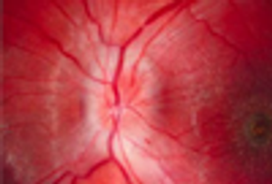 A Young Woman With Sudden Loss of Vision in One Eye