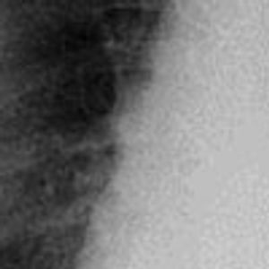 Chilaiditi Syndrome