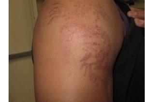 Temporary Henna Tattoo Could Leave an Indelible Mark