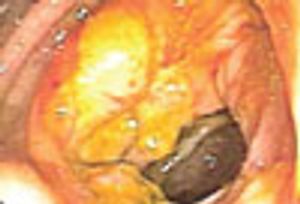 Apple Core Lesion
