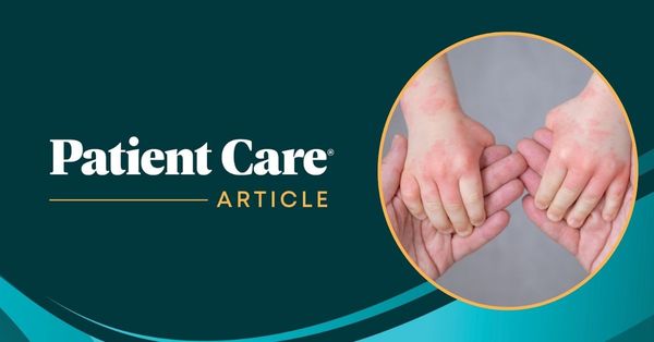 Topline Phase 2 Data Show Roflumilast Cream Improves Atopic Dermatitis in Infants as Young as 3 Months