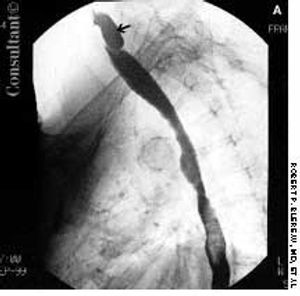 Zenker Diverticulum in an Older Woman