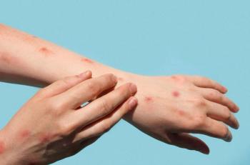 Mpox Outbreak: 5 Things to Know if Patients Ask / image credit  ©Marina Demikiuk/stock.adobe.com