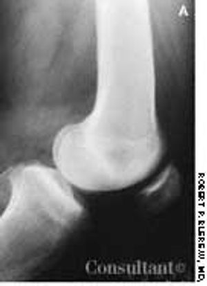 MRI Diagnosis of Bone Bruise