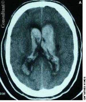 Acute Aneurysm Rupture