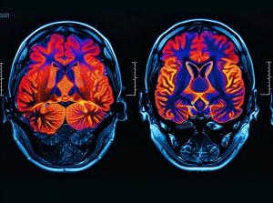 Precision Medicine Protocol for Cognitive Decline Also Reduces Depression, New Data Suggest image credit ©Maxim/stock.adobe.com