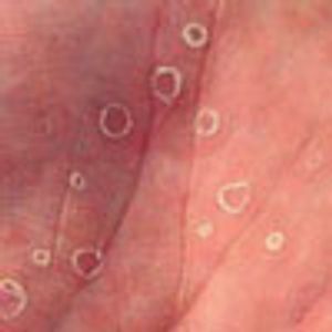 Secondary Syphilis and HIV Positivity