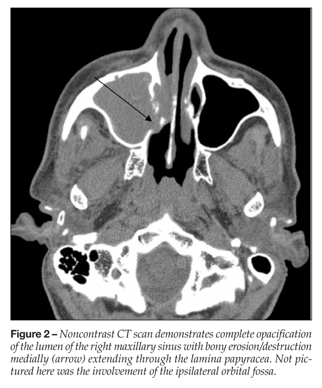 Invasive Fungal Sinusitis