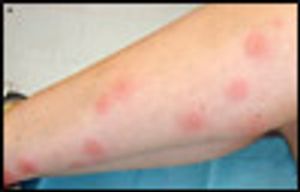 Ectoparasite Bites