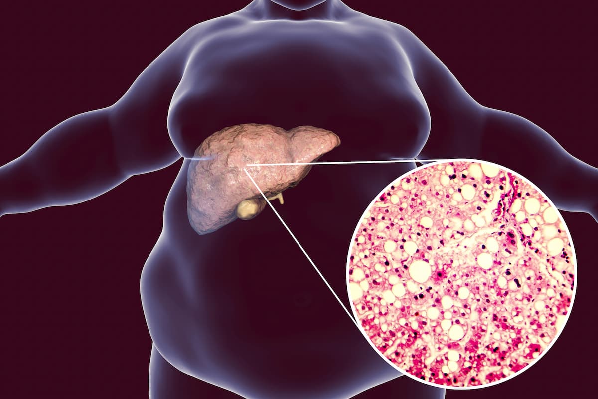 STUDY: Novel “Triagonist” Retatrutide Resolved Steatosis in Over 85% of Patients with MASLD and Obesity