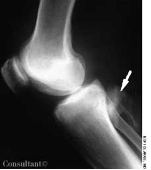 Synovial Osteochondromatosis