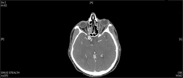 Orbital Pseudotumor Disguised As Orbital Cellulitis And Sinusitis