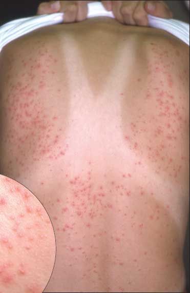 Folliculitis Part I Folliculitis Part I