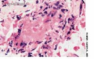 Pauci-Immune Crescentic Glomerulonephritis