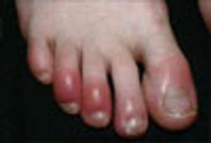 Persistent Pain in the Toes After Hiking