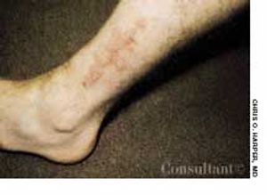 Lichen Planus: Quick Tips