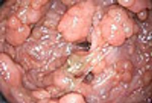 A Young Man With Thousands of Colorectal Polyps: Anomalous and Benign? Or, Something Else?