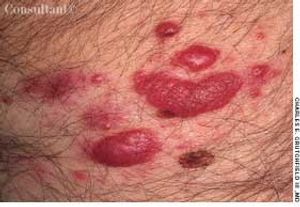 Cutaneous Lymphoid Hyperplasia