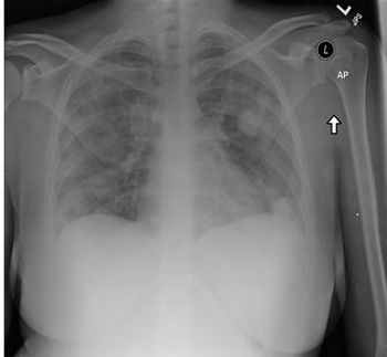 Lemierre syndrome 
