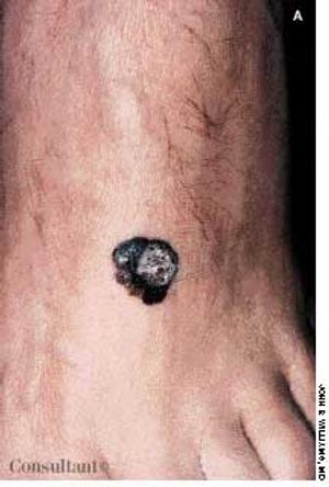 Melanoma of the Foot: Often Overlooked