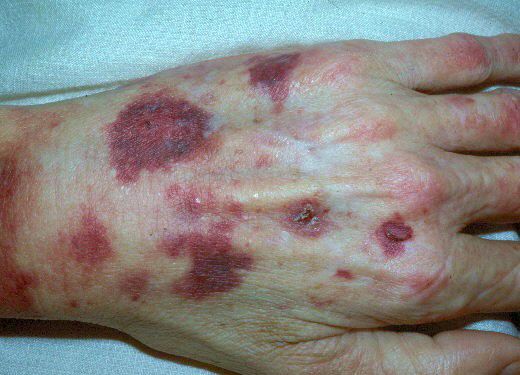 tirzepatide bruise Scurvy: Easy Bruising and Bleeding Gums tirzepatide bruise Scurvy: Easy Bruising and Bleeding Gums