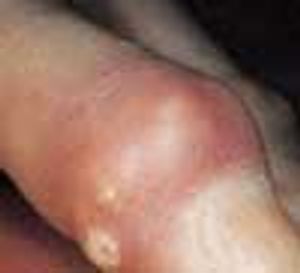 Acute Gouty Arthritis and Gouty Tophus