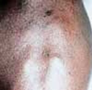 Wegener's Granulomatosis (WG)