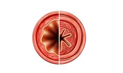 Rademikibart Demonstrates Improved Lung Function, Reduced Exacerbations in People with Eosinophilic-Driven Type 2 Asthma