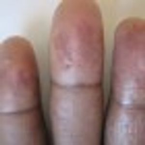 Raynaud Phenomenon as a Manifestation of Systemic Disease