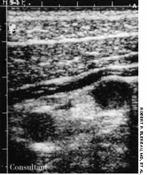 Acute Appendicitis: Two Cases