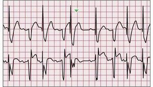 Pacemakers and AICDs: Nomenclature and Malfunction