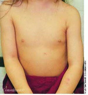 Reaction to Chickenpox Vaccine