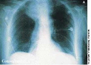 Intrathoracic Goiter