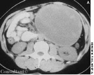 Papillary Cystic Neoplasm of the Pancreas
