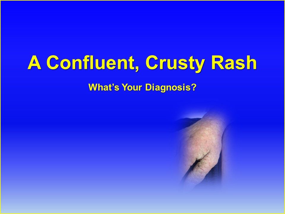Confluent Rash Pattern A Confluent, Crusty Rash